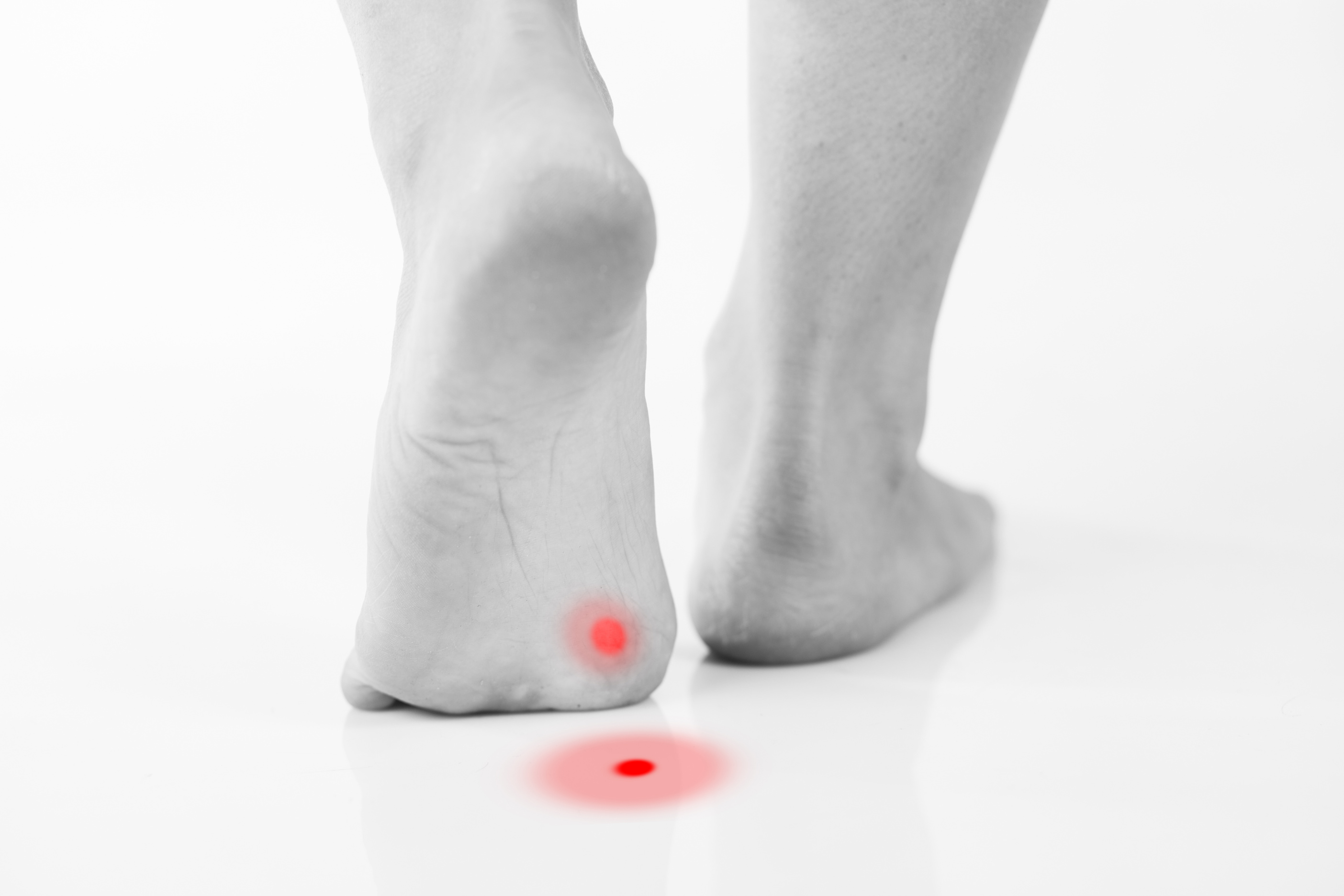 Callus or plantar wart under foot
