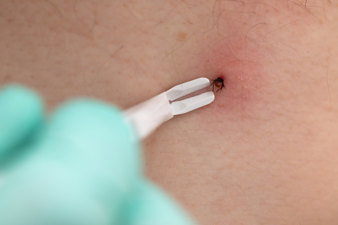 Removing tick from human skin