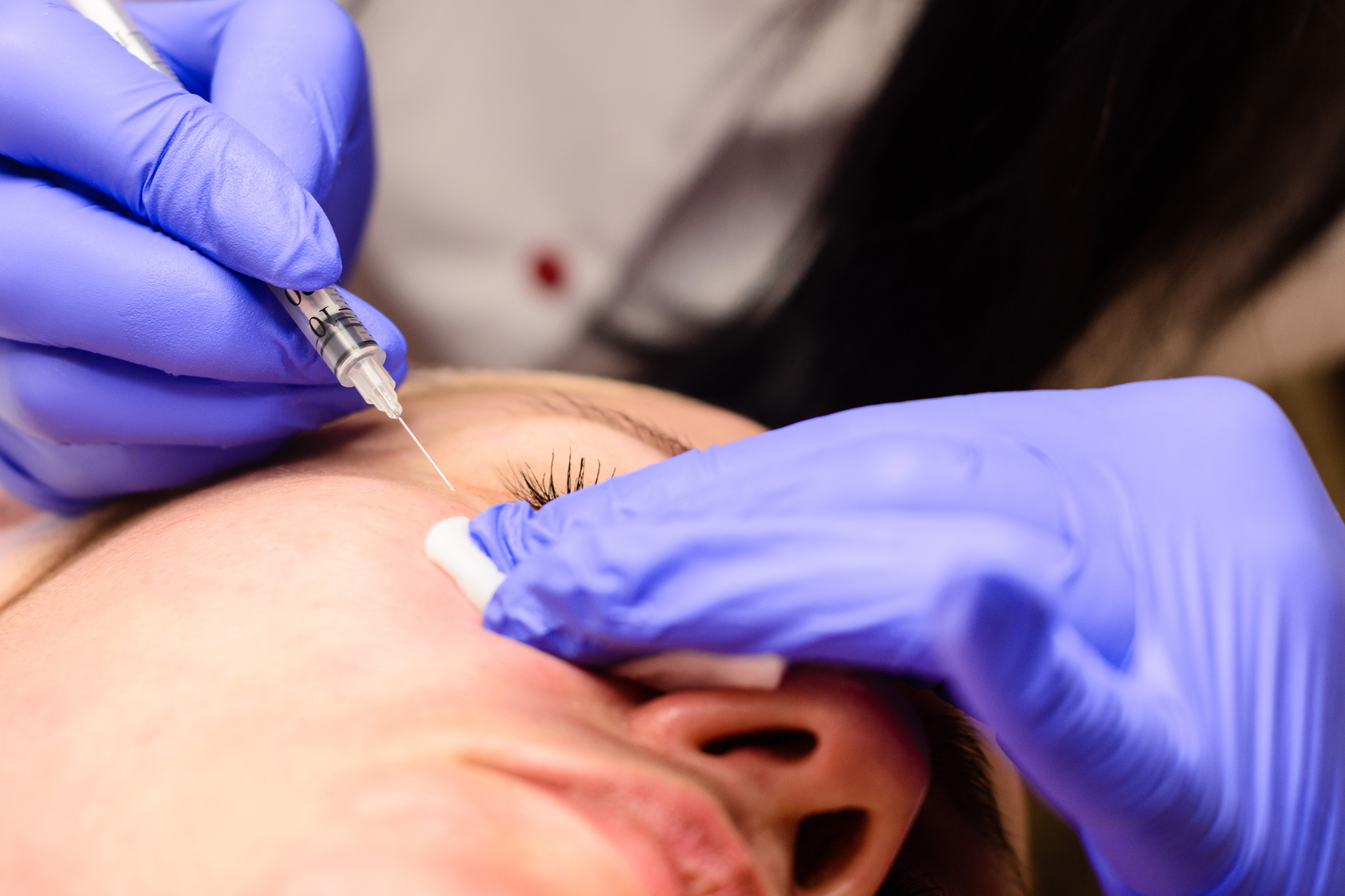 Milium on the face, removal of milia with a syringe in cosmetology.
