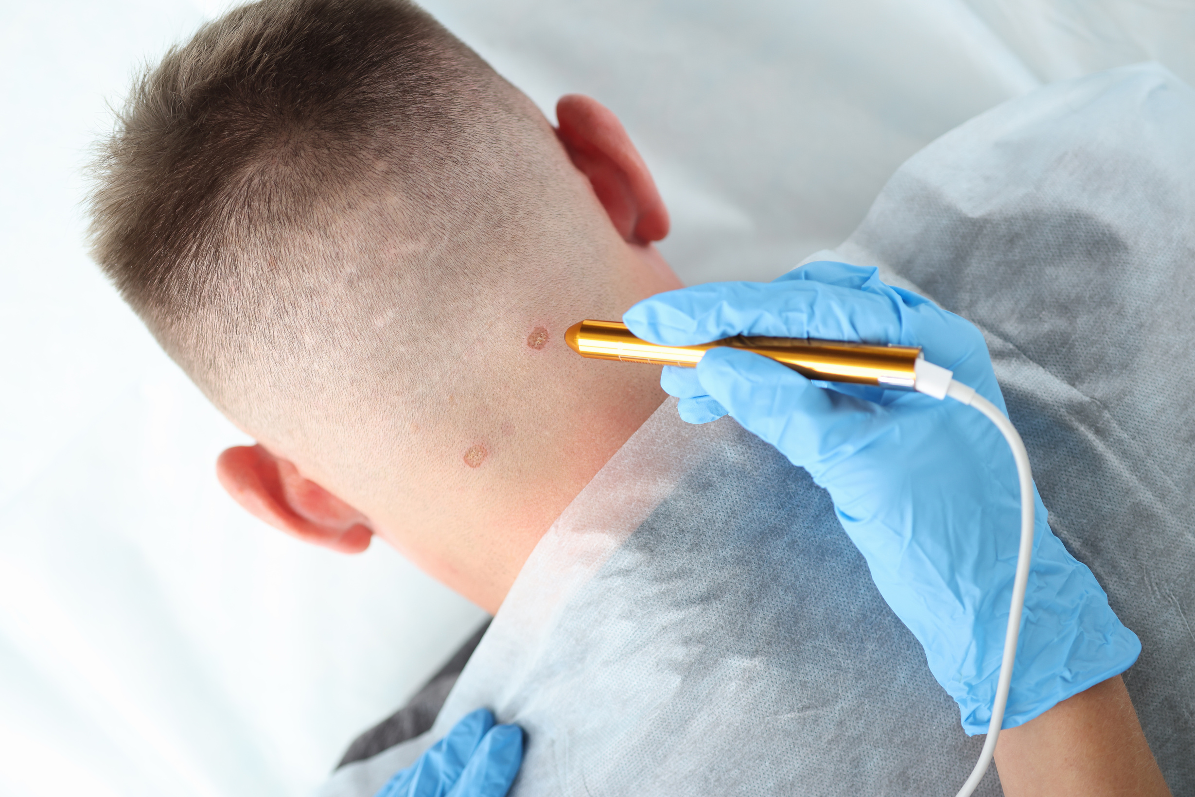 Traces on Male Neck after Laser Removal Closeup